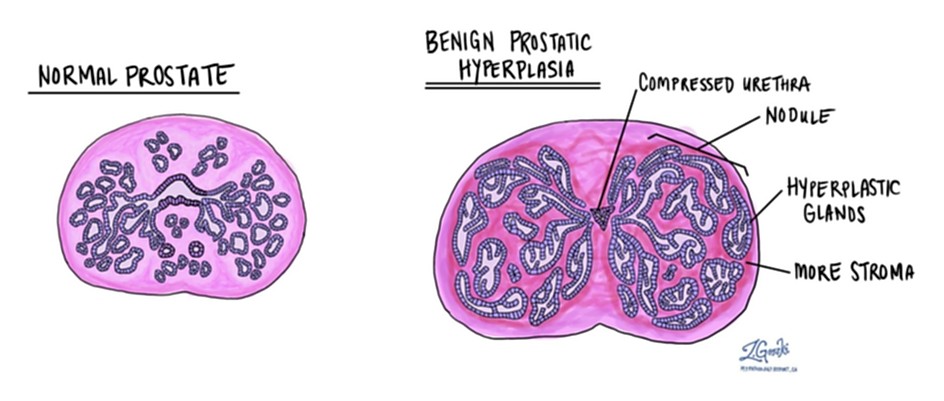 cancer with benign prostatic hyperplasia