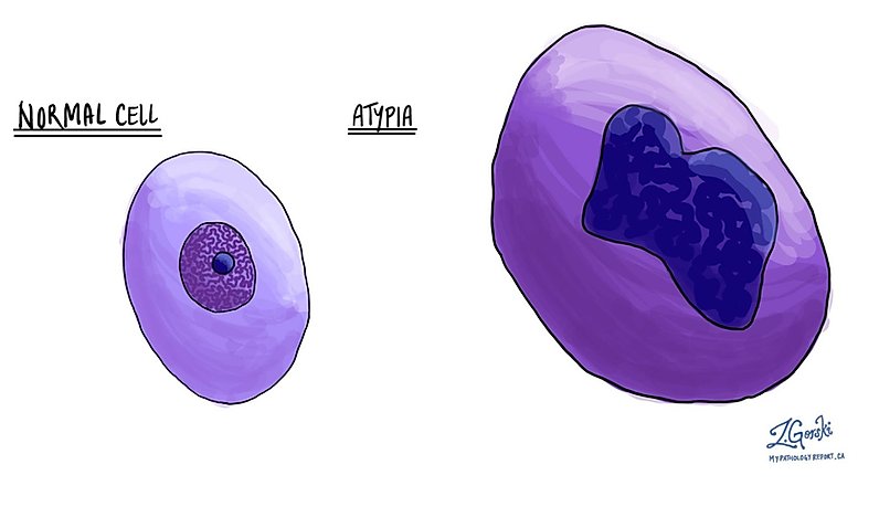atypical cell