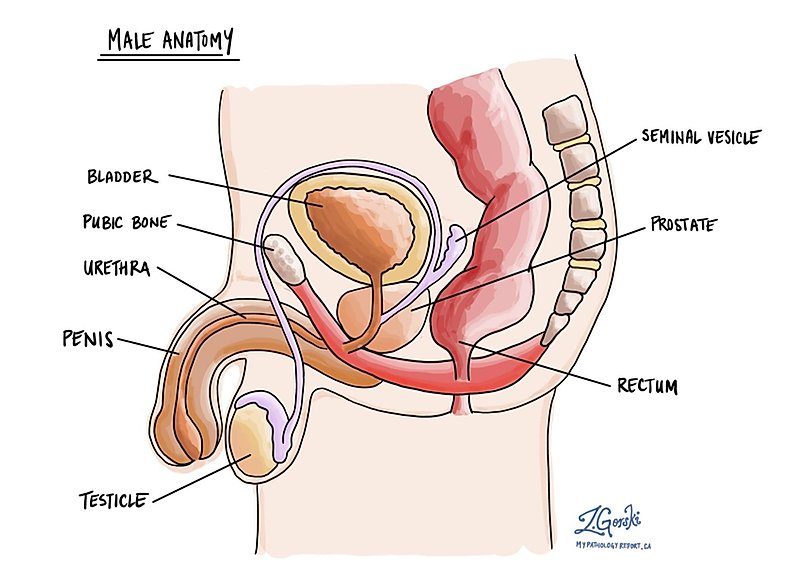 prostata neoplasia