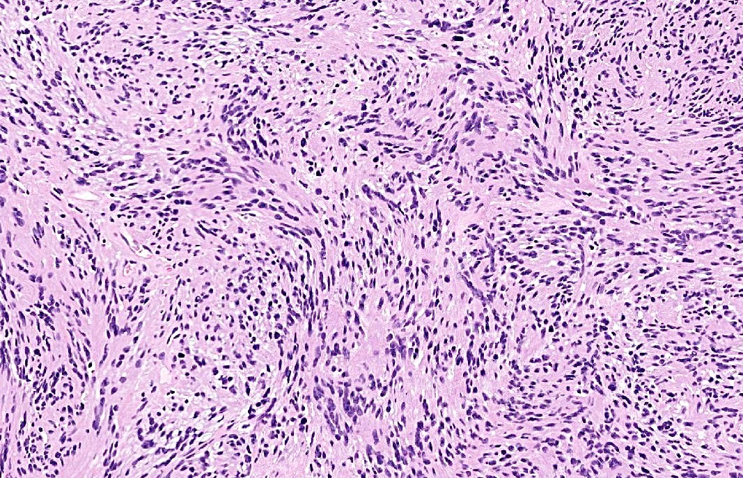 Schwannoma | MyPathologyReport.ca