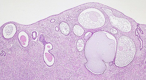 Pathology of the endometrium