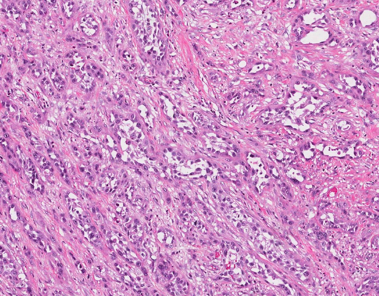 Urothelial carcinoma of the bladder | MyPathologyReport.ca