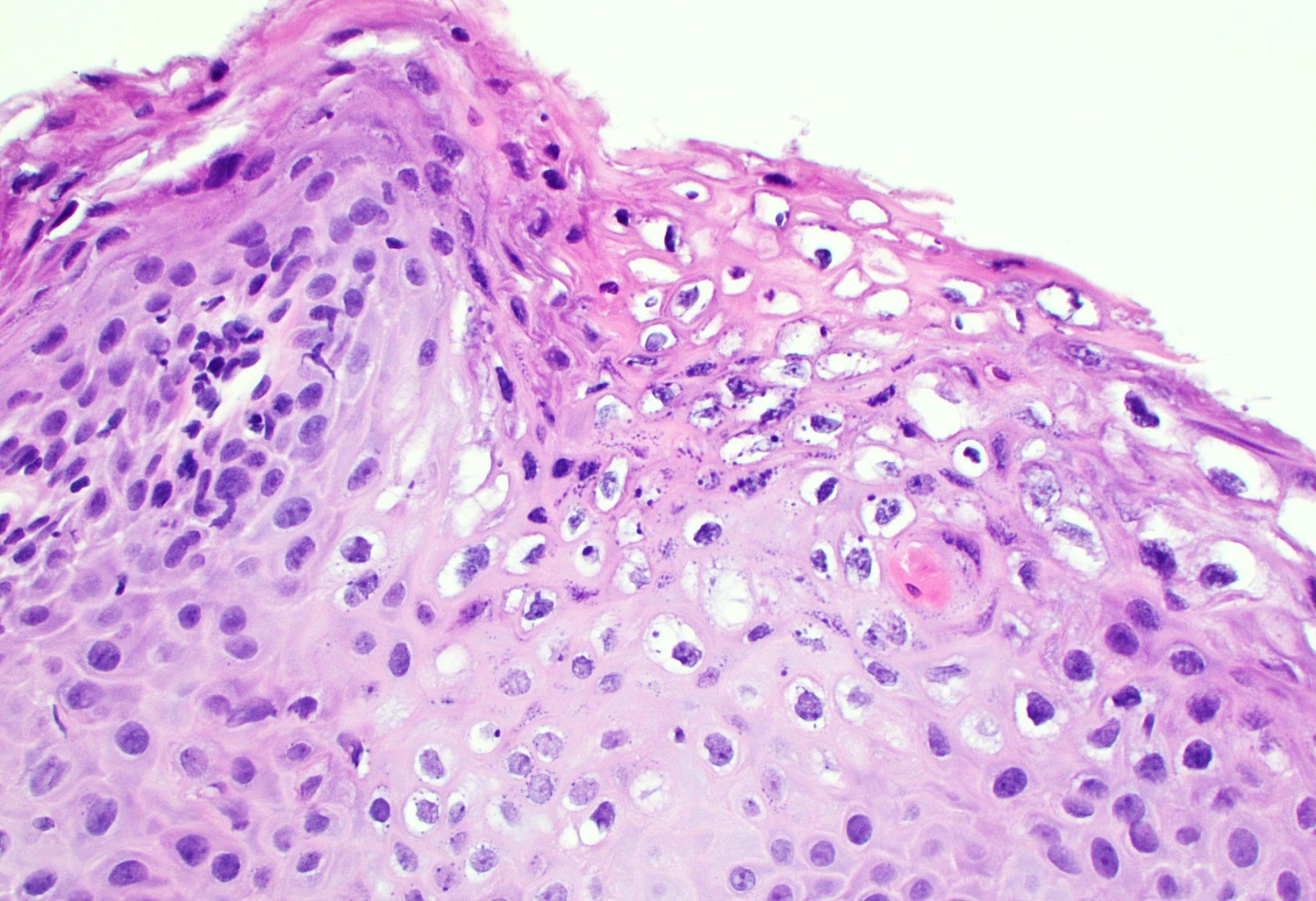 Low grade squamous intraepithelial lesion of the vulva