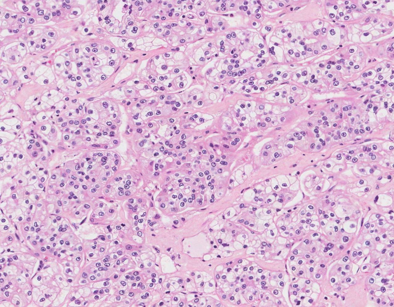 淡明細胞型腎細胞癌 Mypathologyreport Ca
