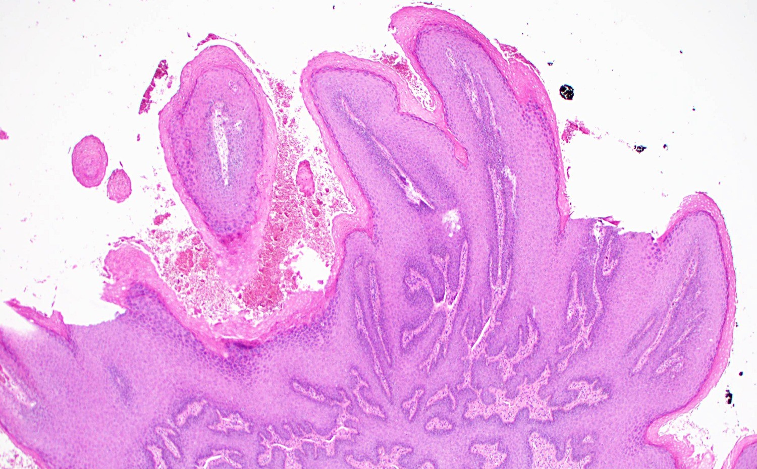 condyloma acuminatum vulva histology