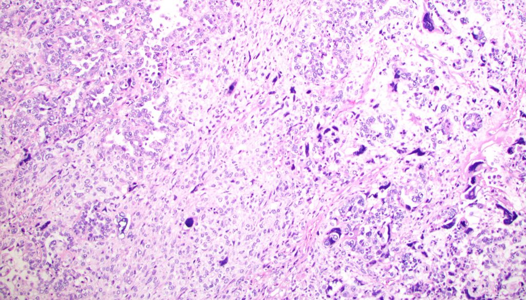 Carcinosarcoma Uterus MyPathologyReport ca
