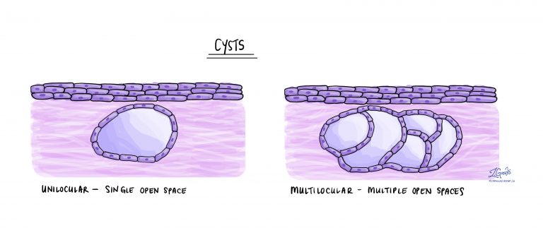 What Is A Cyst MyPathologyReport ca