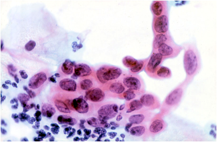 hpv abnormal squamous cells papillomavirus garcon