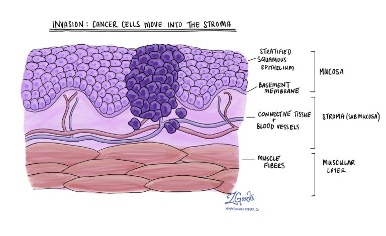 Squamous cell carcinoma - Oral cavity - MyPathologyReport