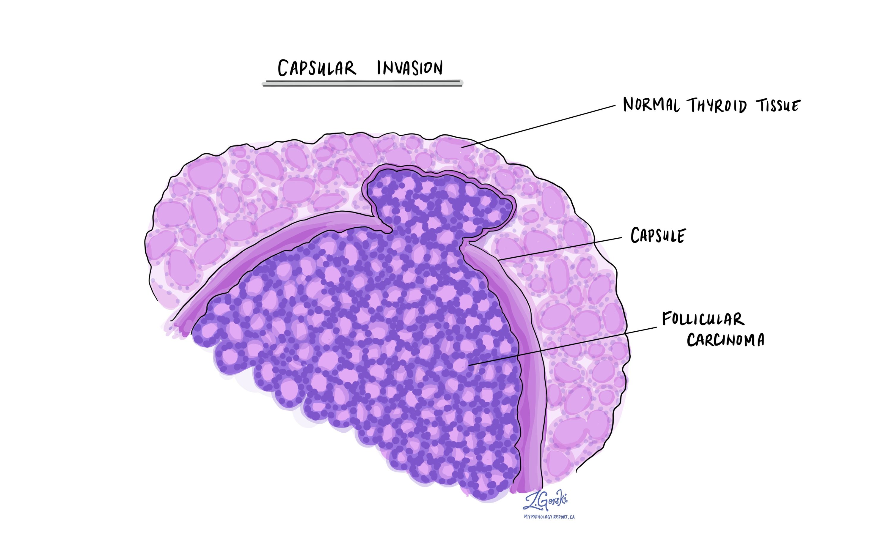Follicular carcinoma Thyroid MyPathologyReport.ca