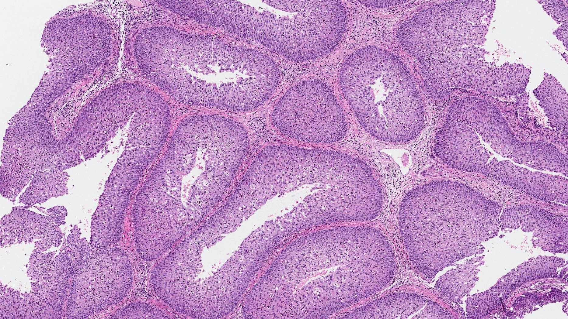 Nasal inverted papilloma histology