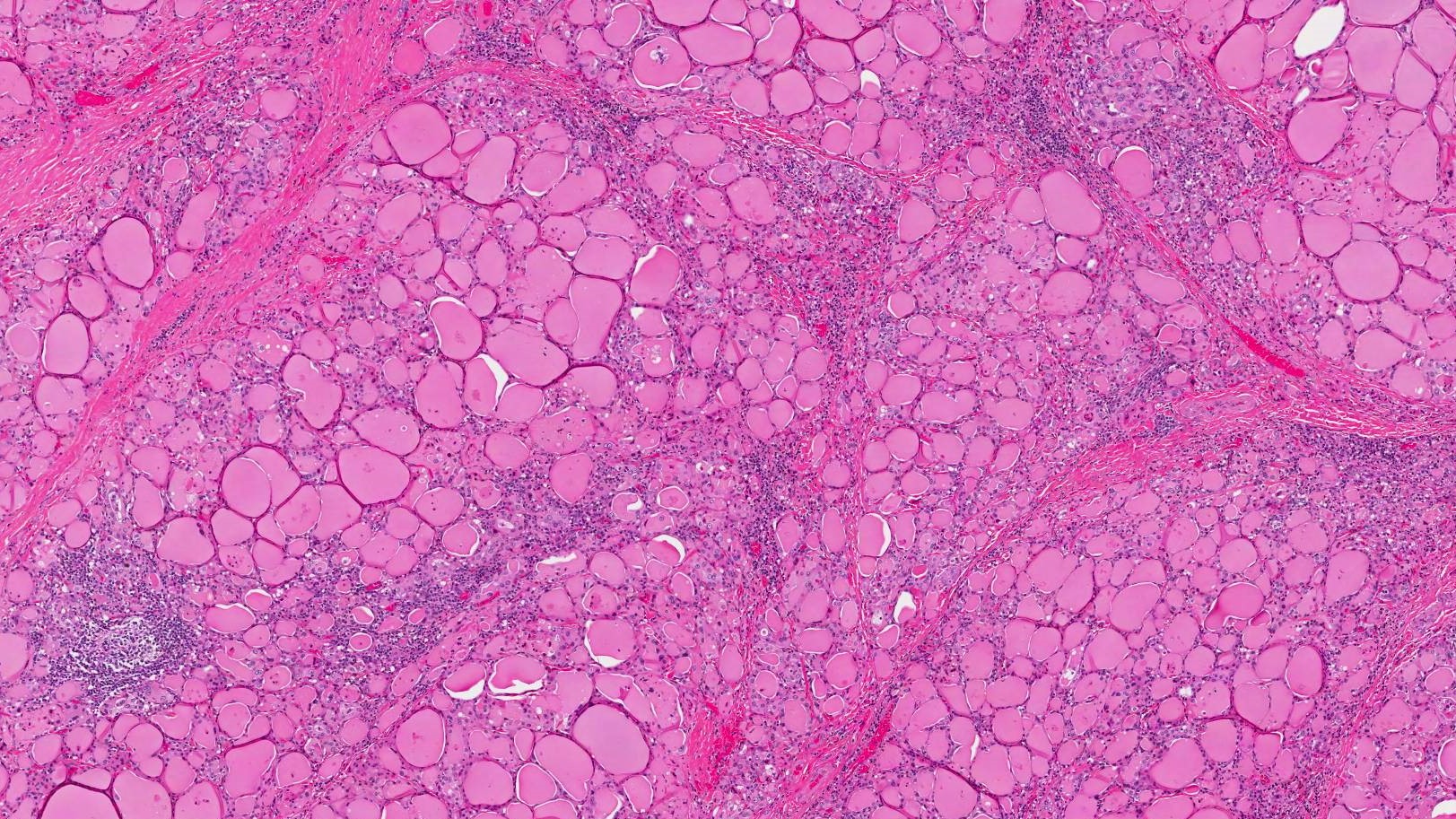 Thyroid Nodular thyroid hyperplasia Thyroid gland