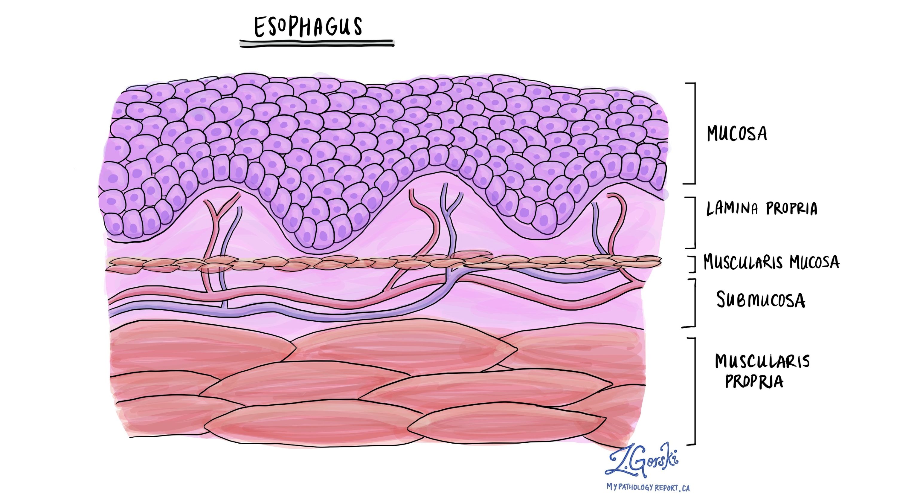 Adenocarcinoma - Esophagus - MyPathologyReport.ca
