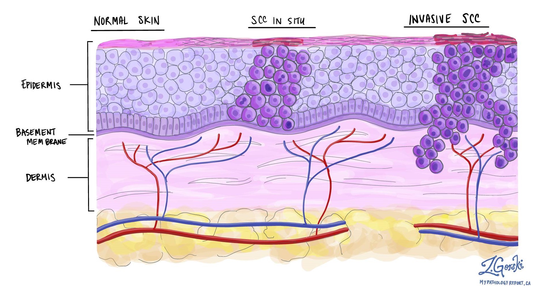 Squamous cell carcinoma of the skin MyPathologyReport.ca