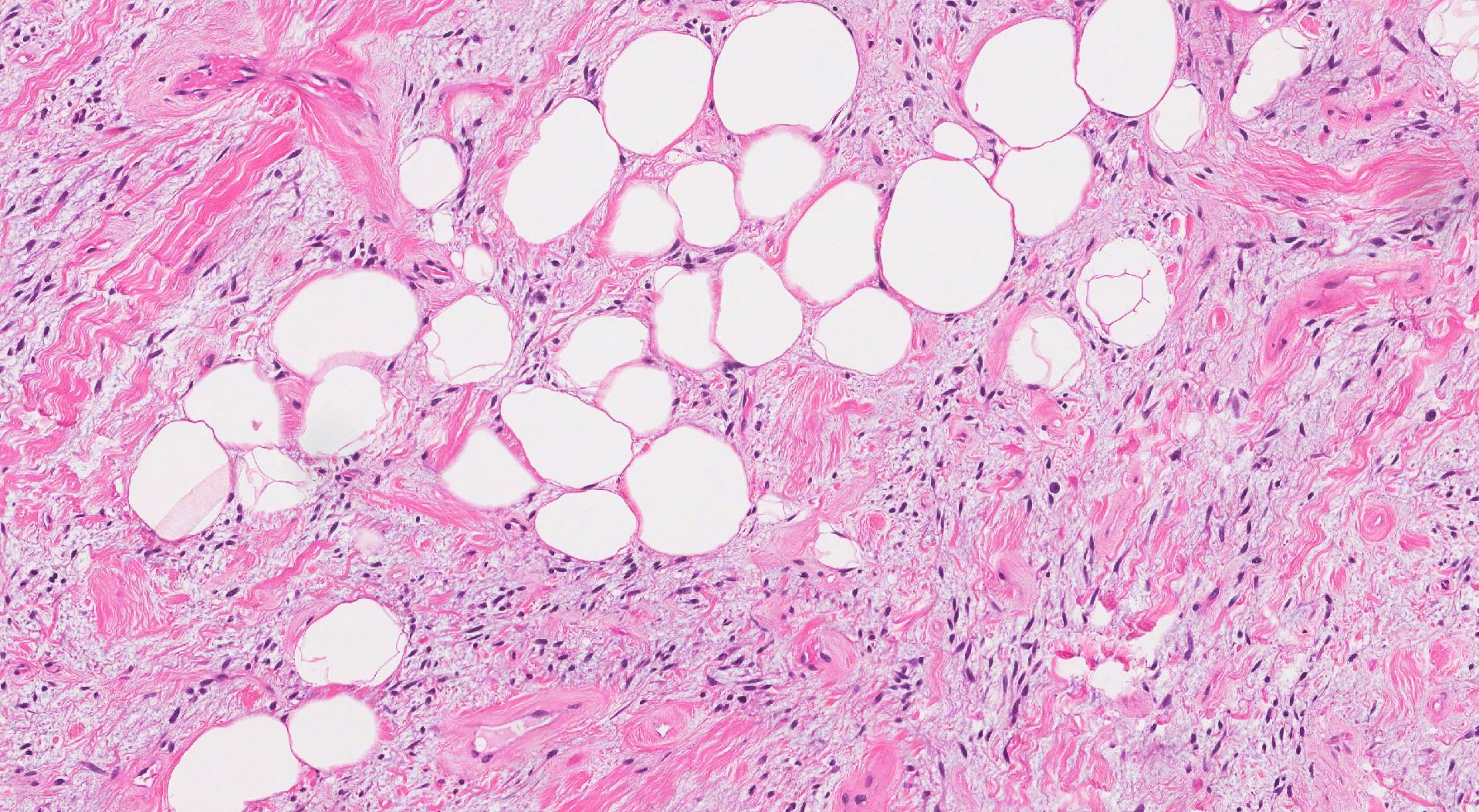 spindle cells and ropey collagen- found in spindle cell lipomas