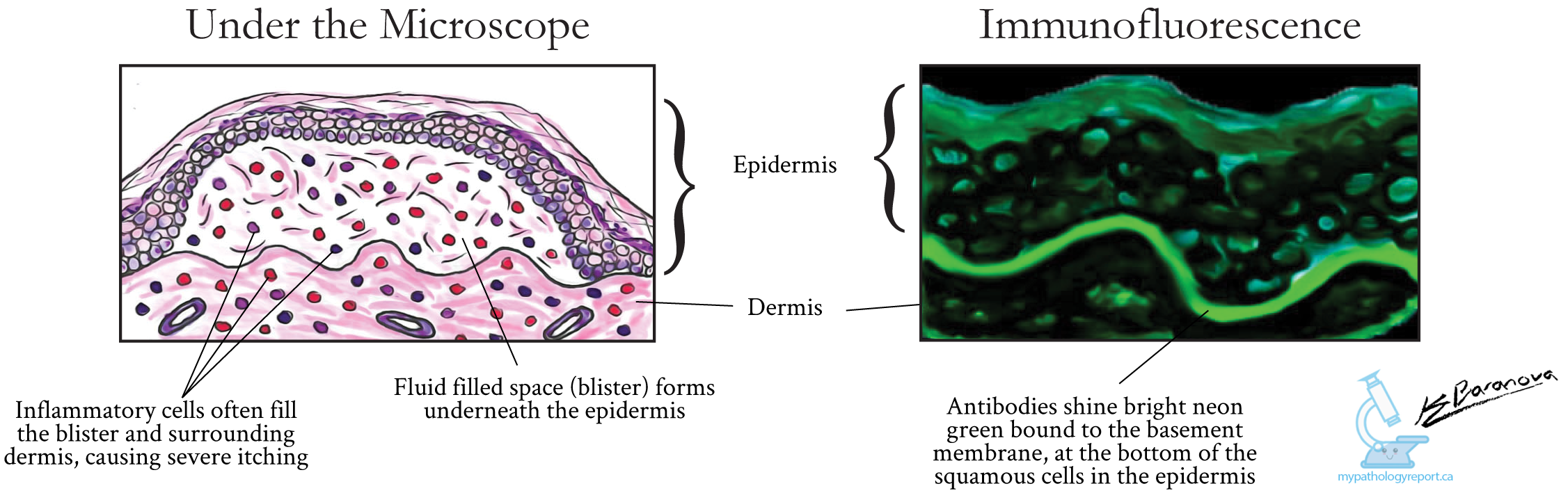 Bullous Pemphigoid Lesions