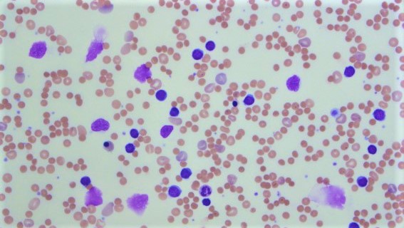 慢性リンパ性白血病 (CLL) の症状症状