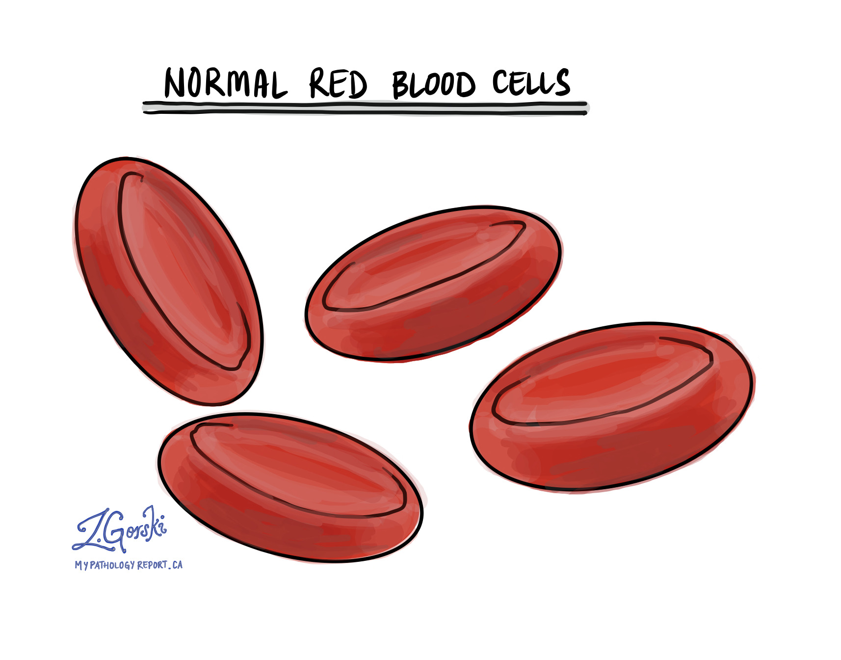 Hemolytic Anemia MyPathologyReport ca