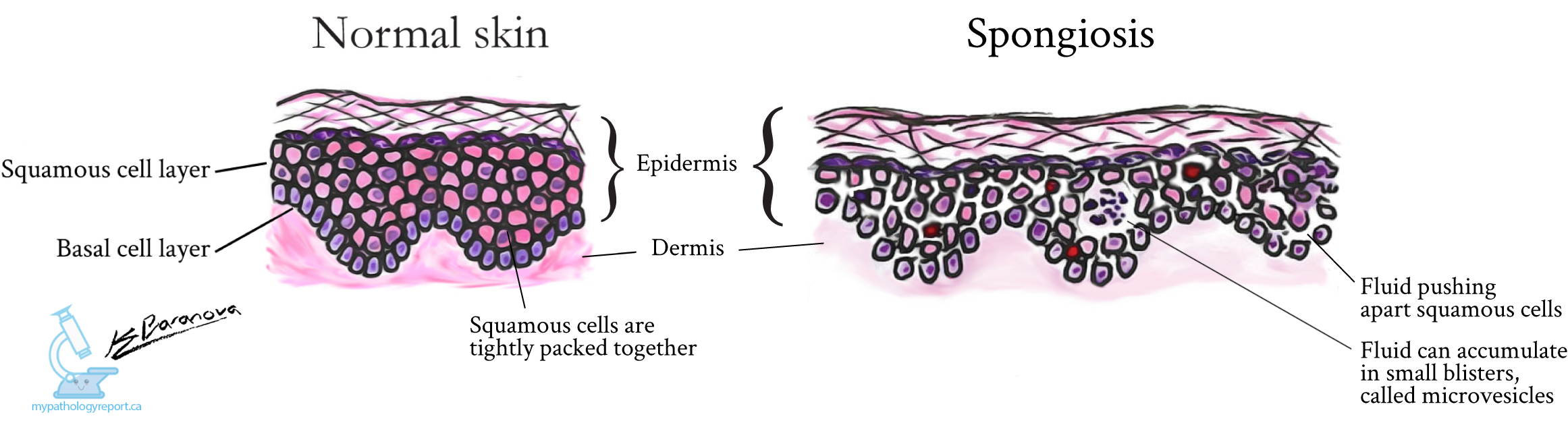 Spongiotic