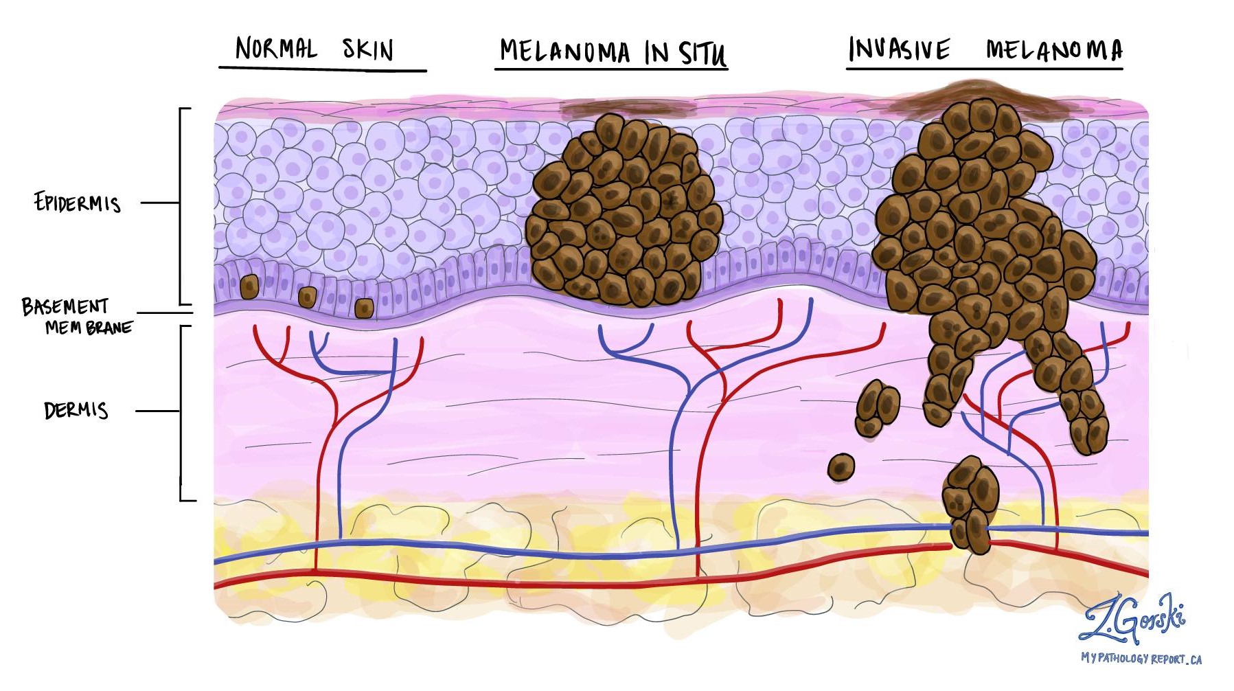 Penyakit Kanker Melanoma In Situ The Spread Of Melanoma Metastasis