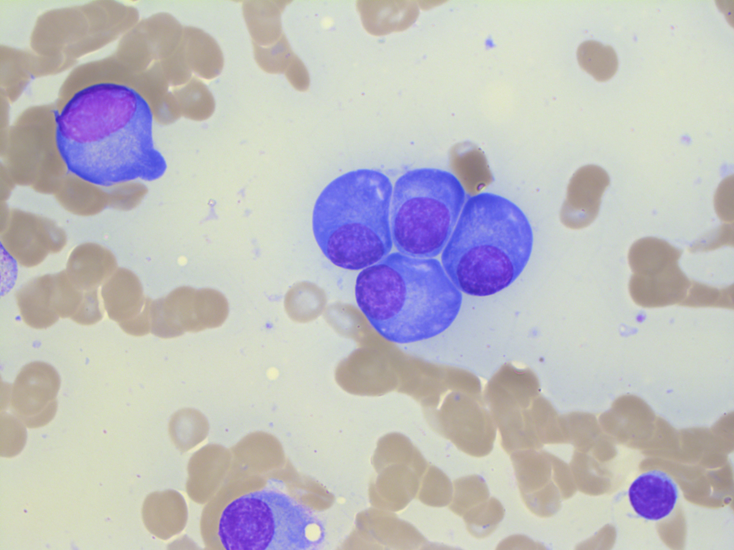 i-plasma cell neoplasm