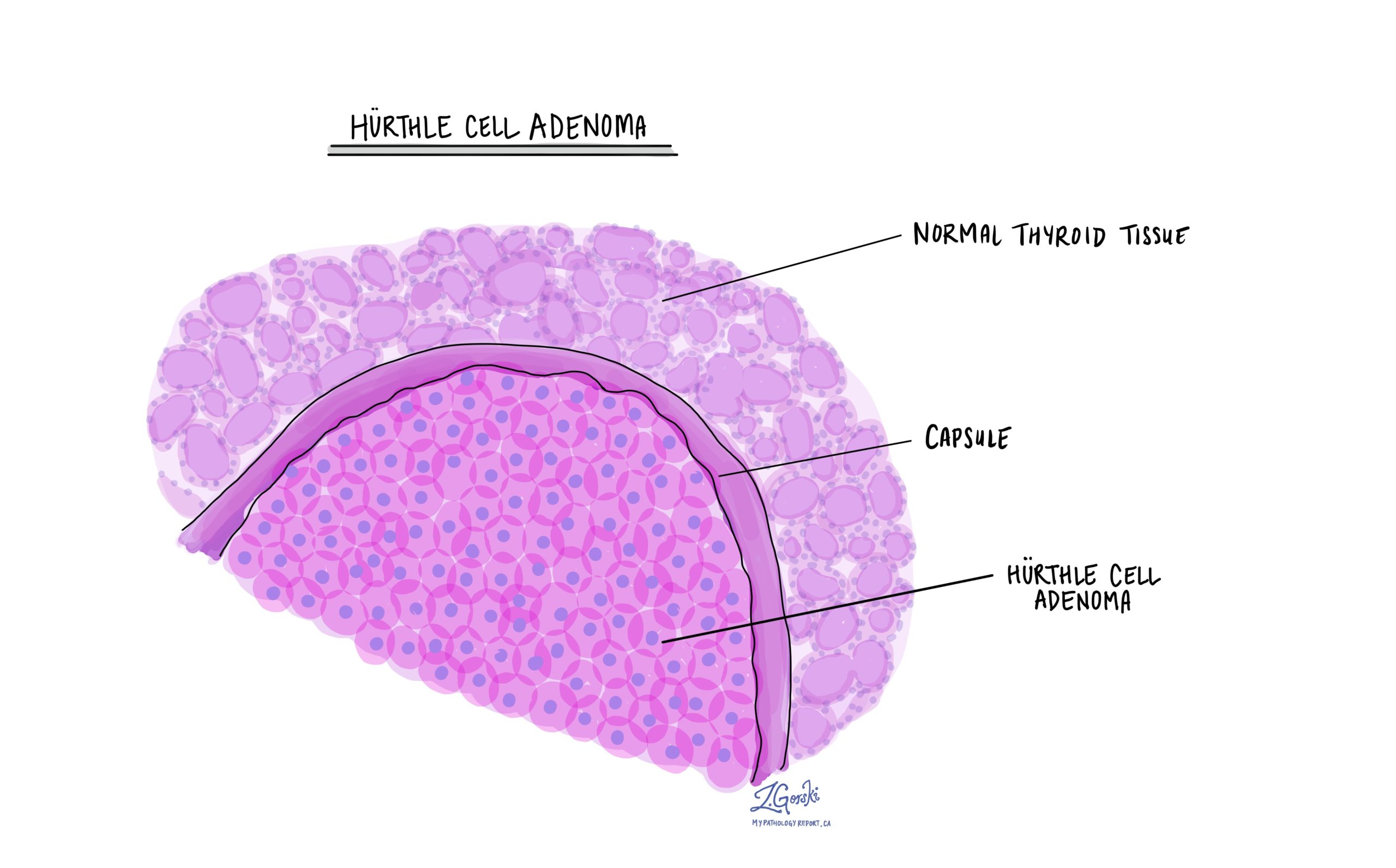 Hurthle cell adenoma | MyPathologyReport.ca