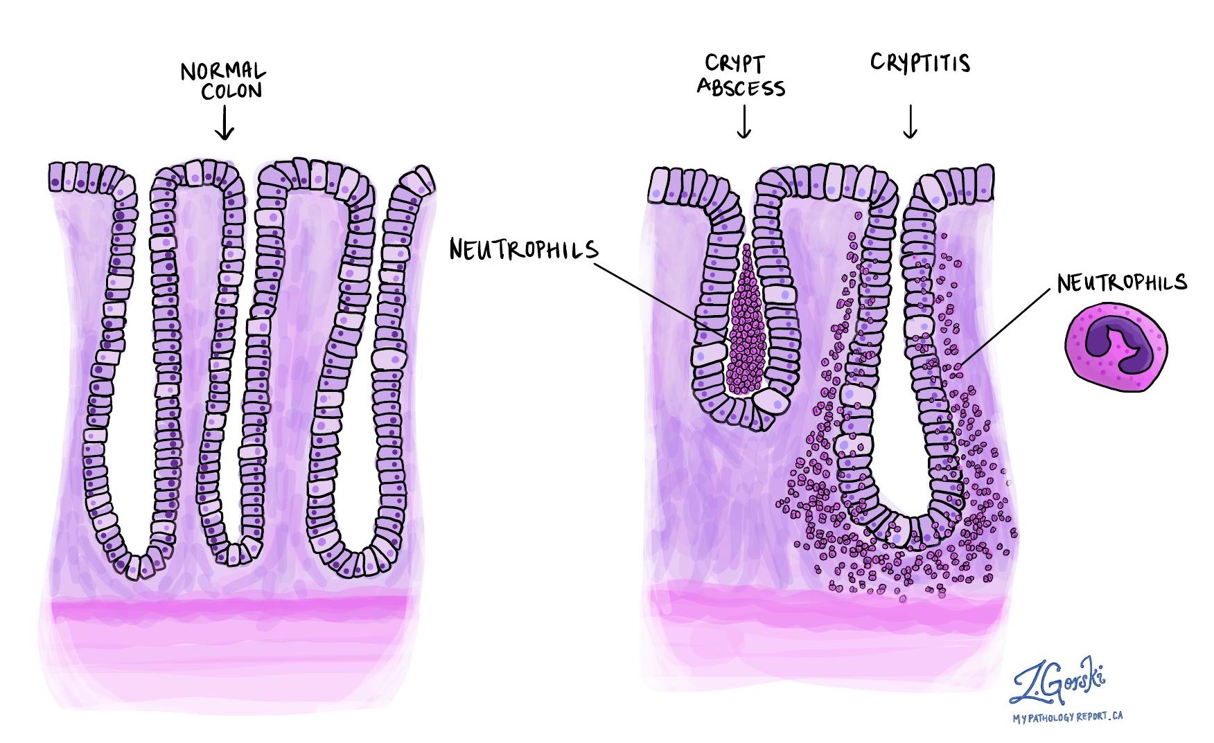陰窩炎の治療選択肢