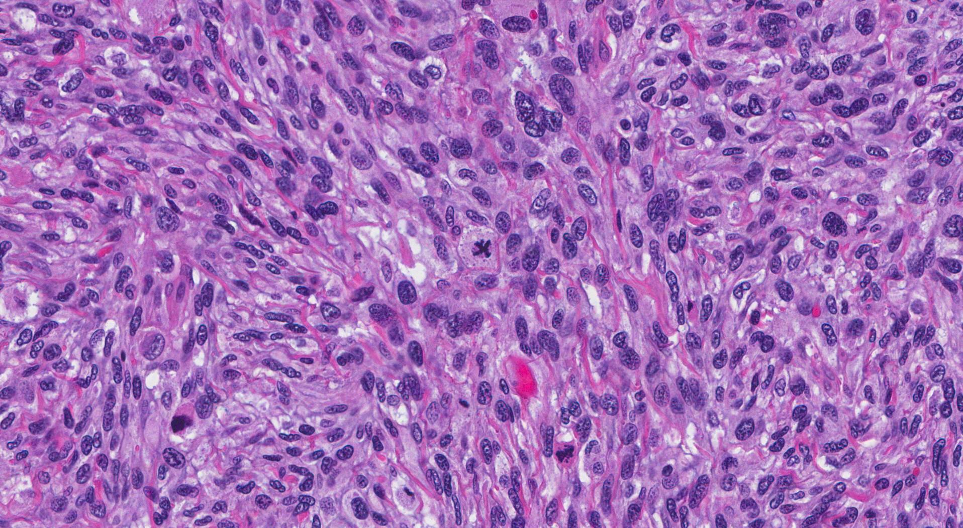 This picture shows an example of a sarcoma arising in soft tissue.