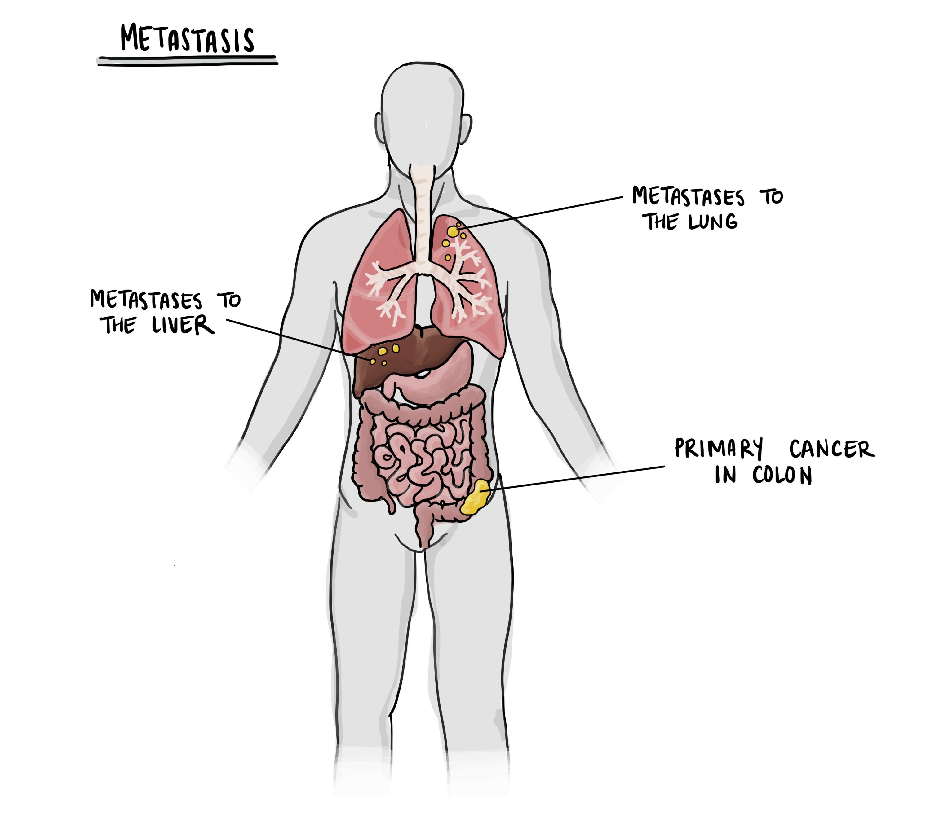 Metastasis Pathology Dictionary MyPathologyReport ca