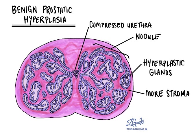 benign prostatic hyperplasia pathology agyalapi mirigy daganat lelki okai