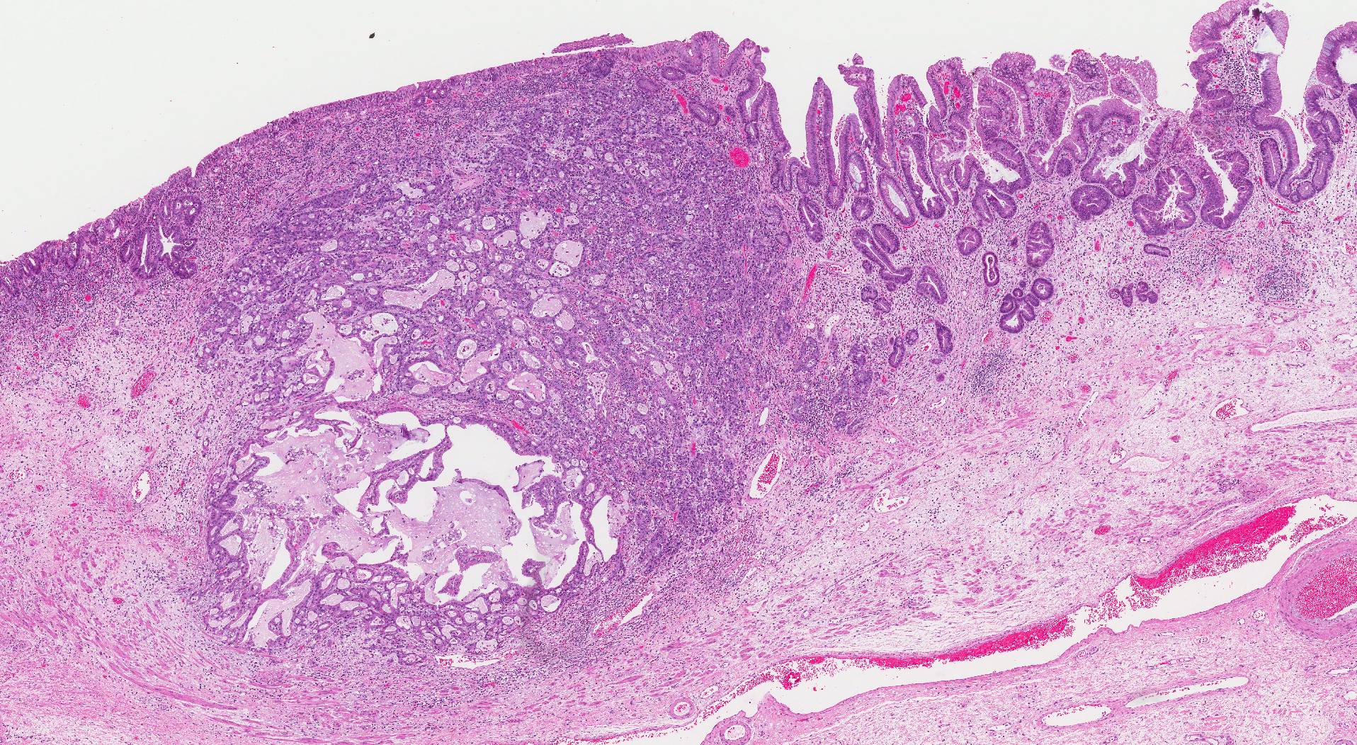 esophagus adenocarcinoma