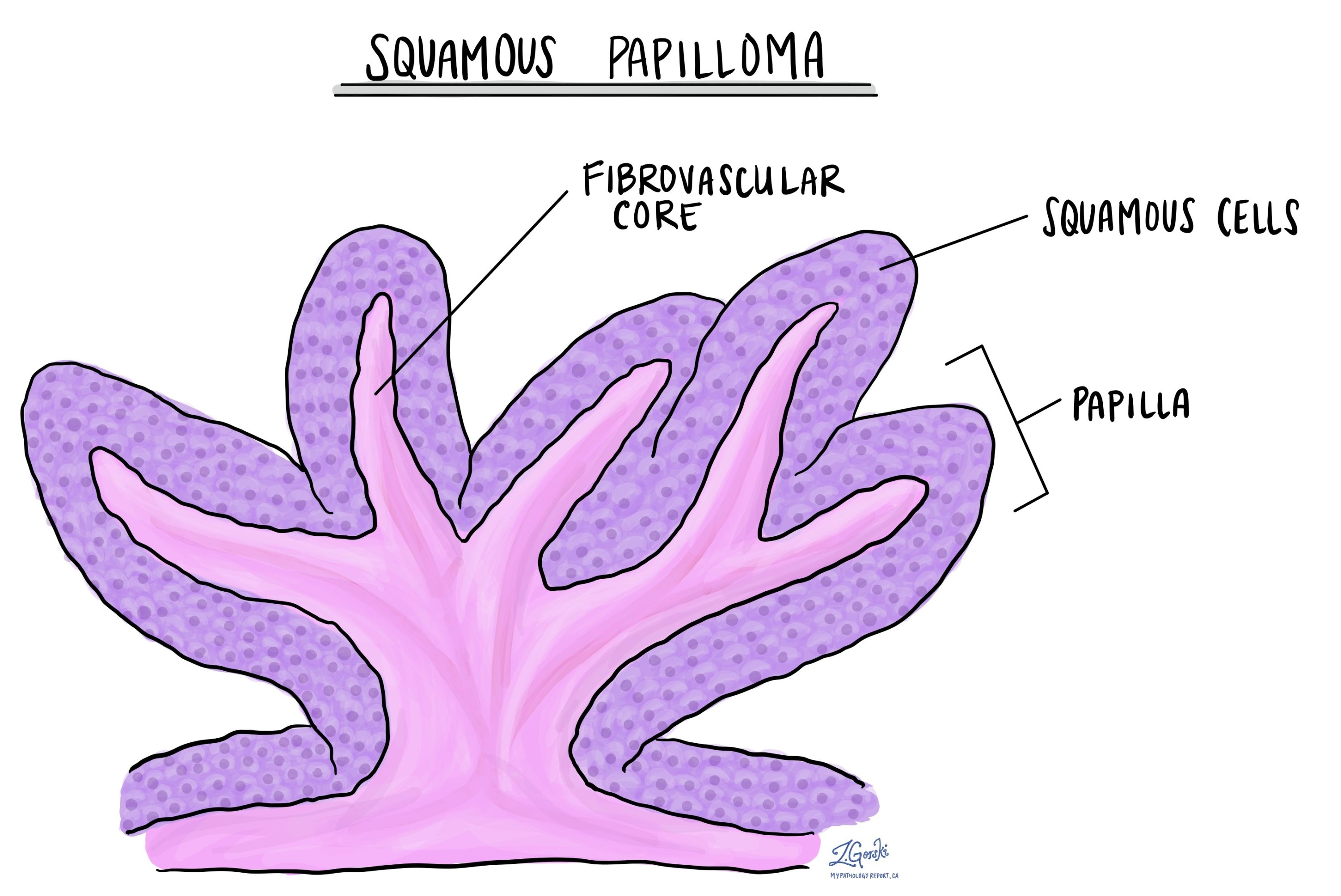 Gingival squamous papilloma, Gingival papilloma histology