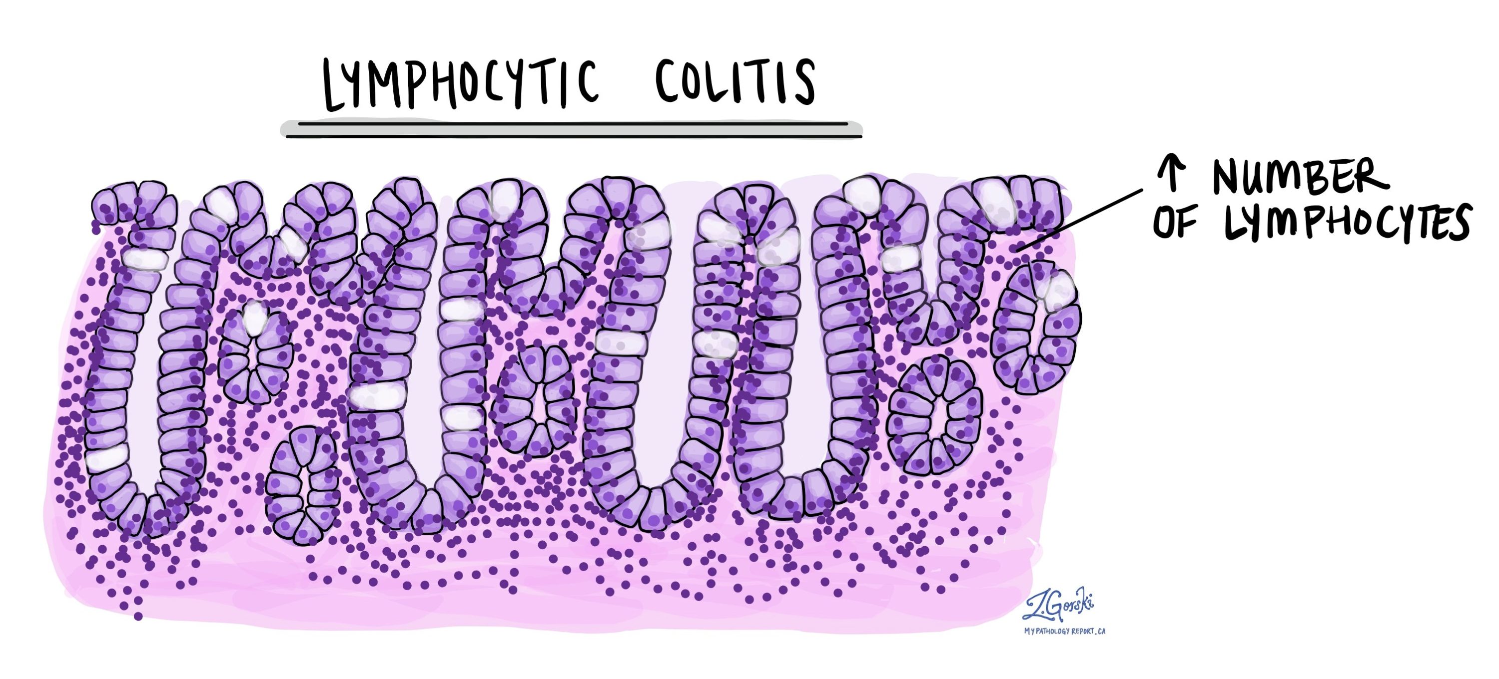 Lymphocytic Colitis