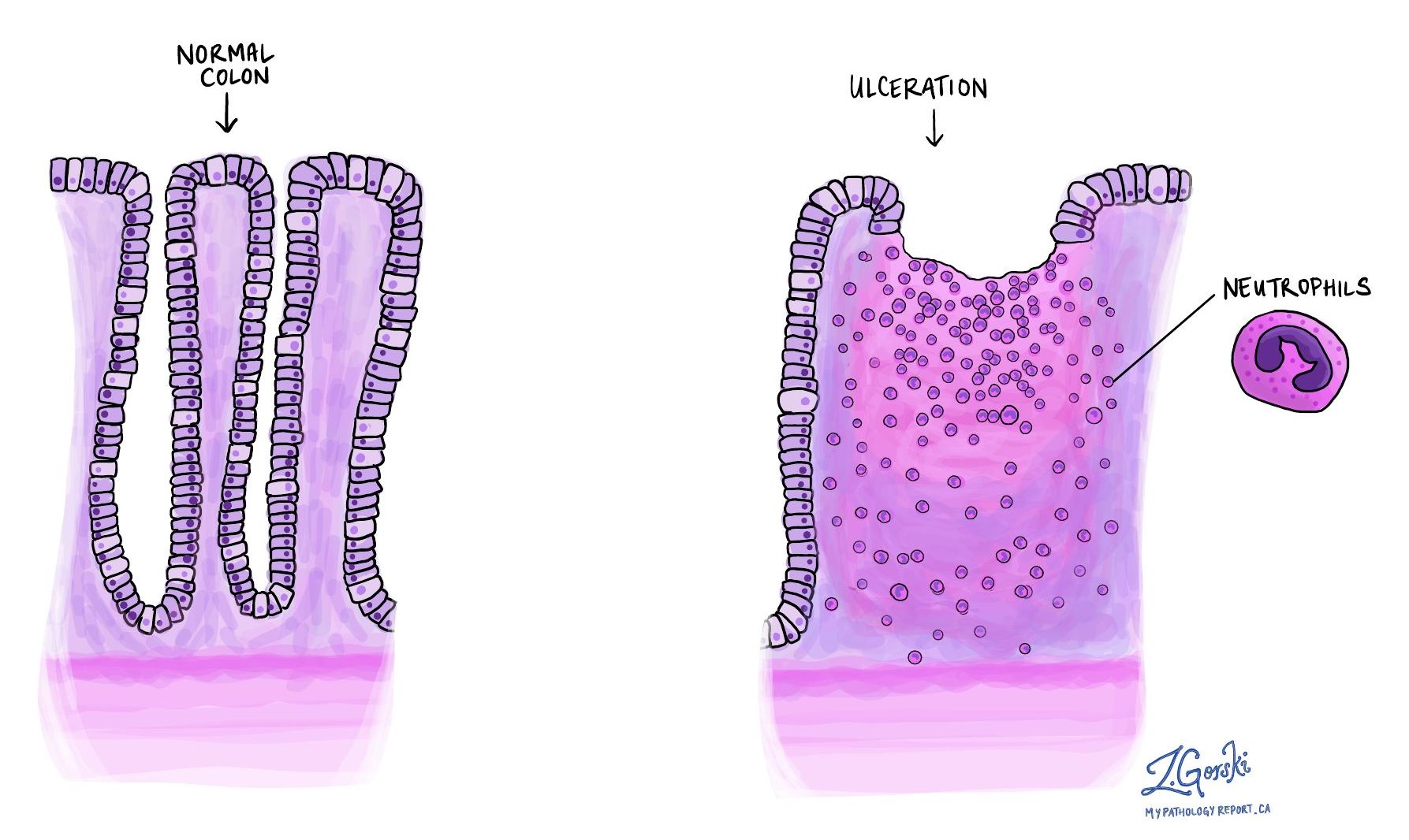 colon ulceration