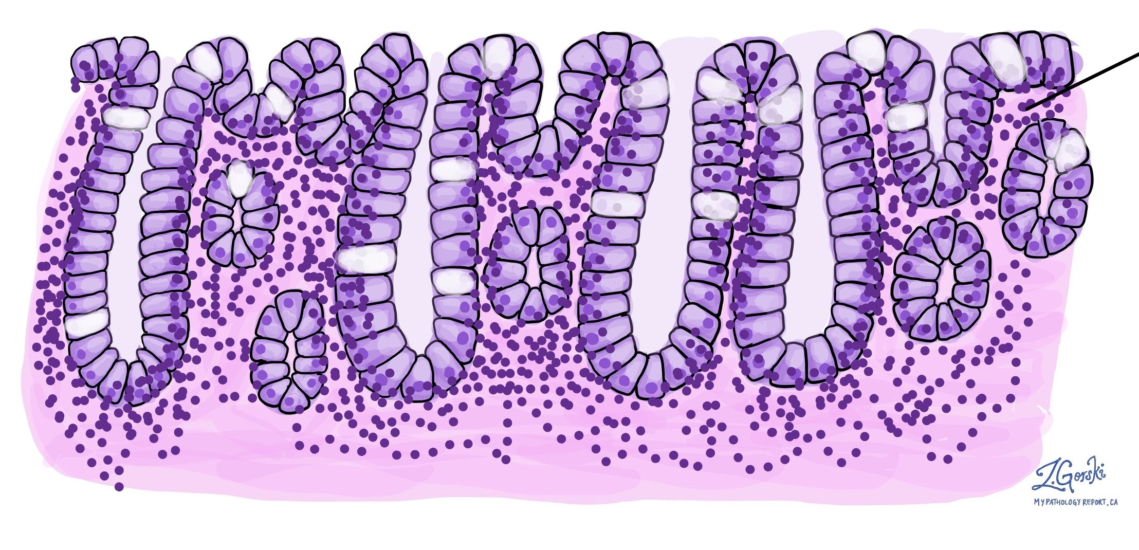 microscopic colitis