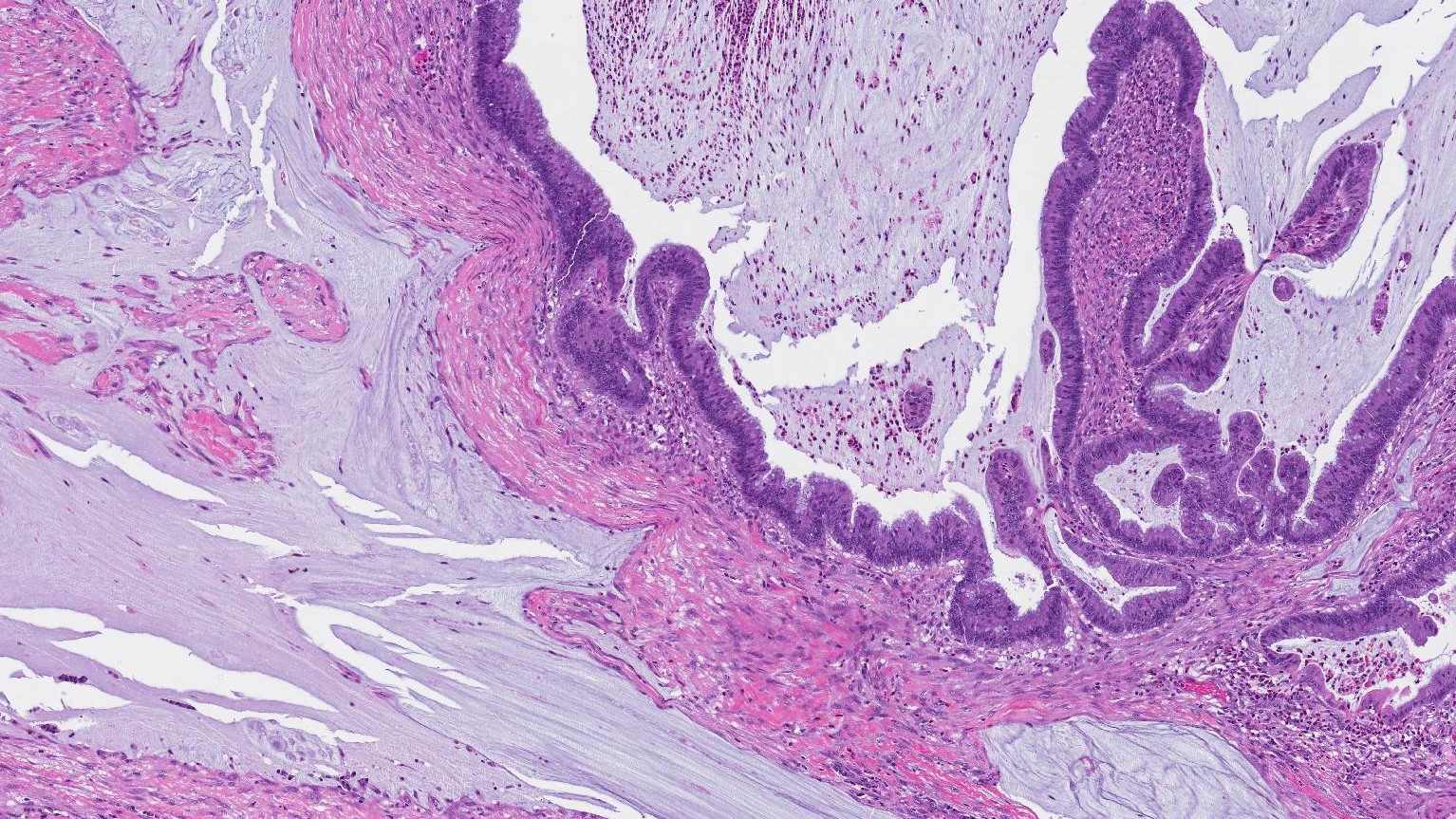 mucinous adenocarcinoma of the colon