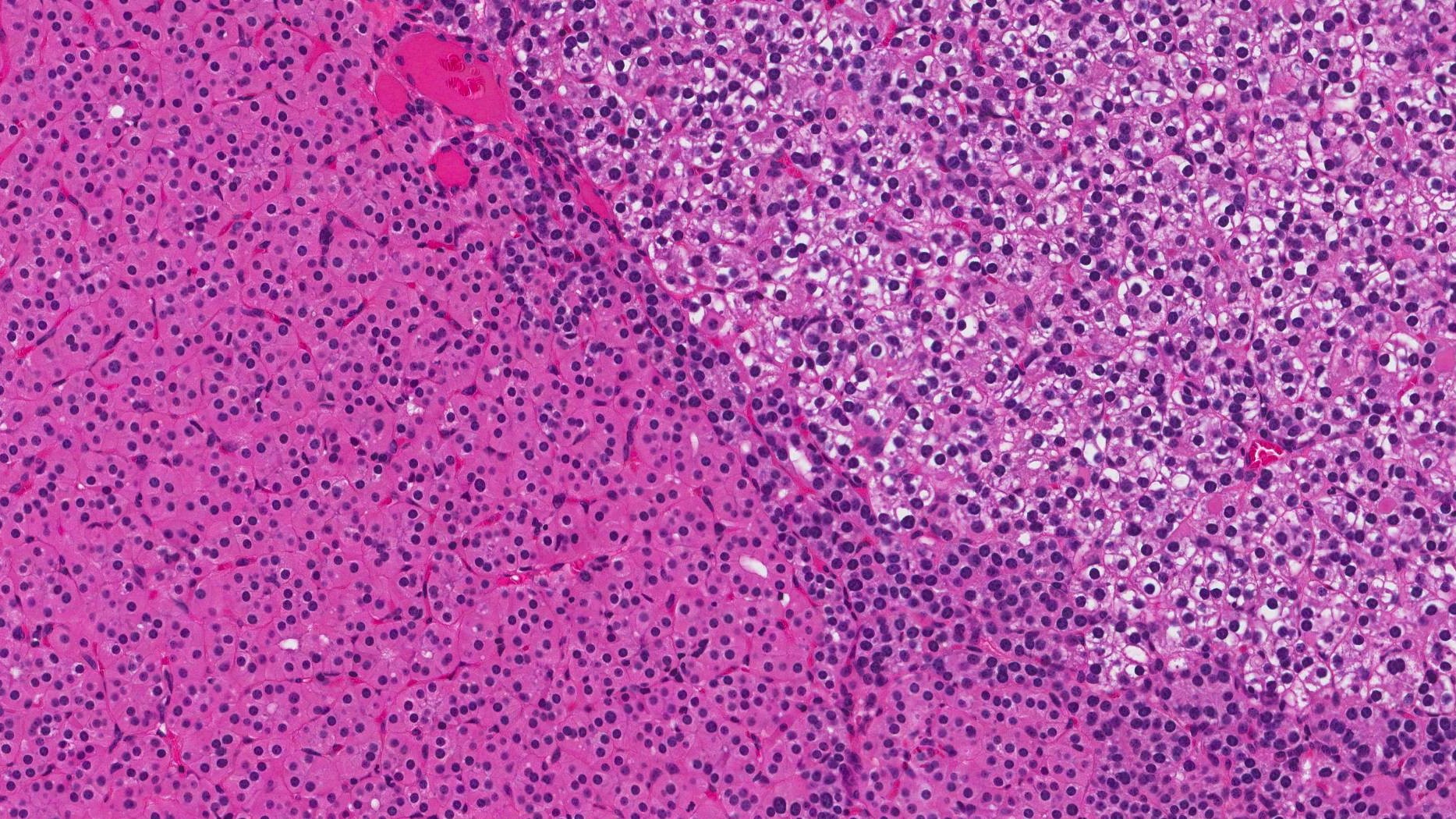 parathyroid adenoma cells