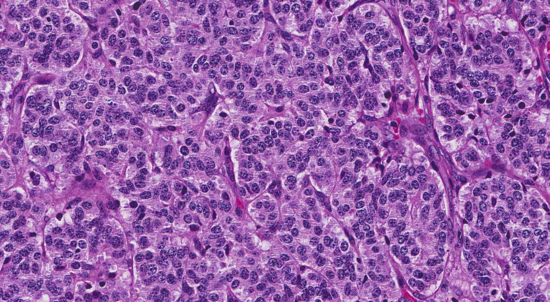atypical carcinoid tumour lung