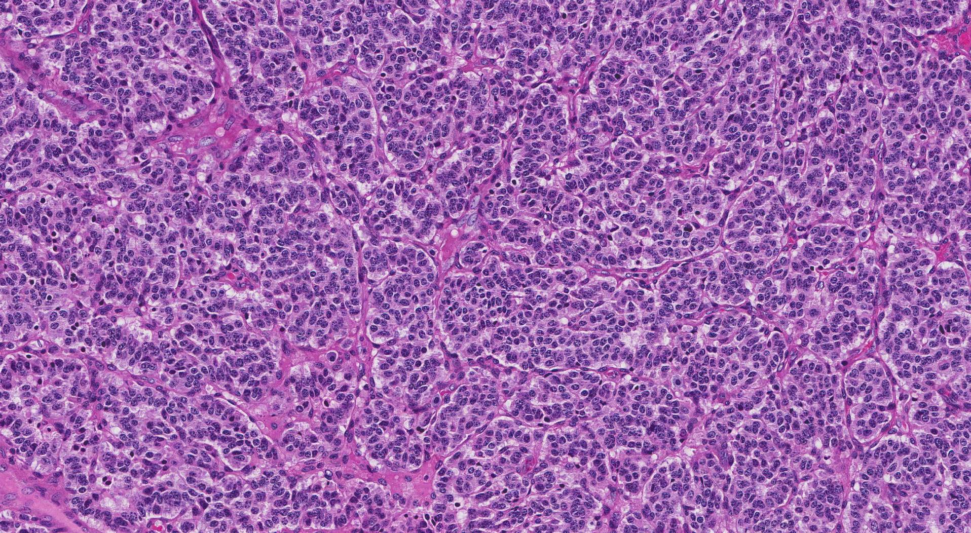 carcinoid lung