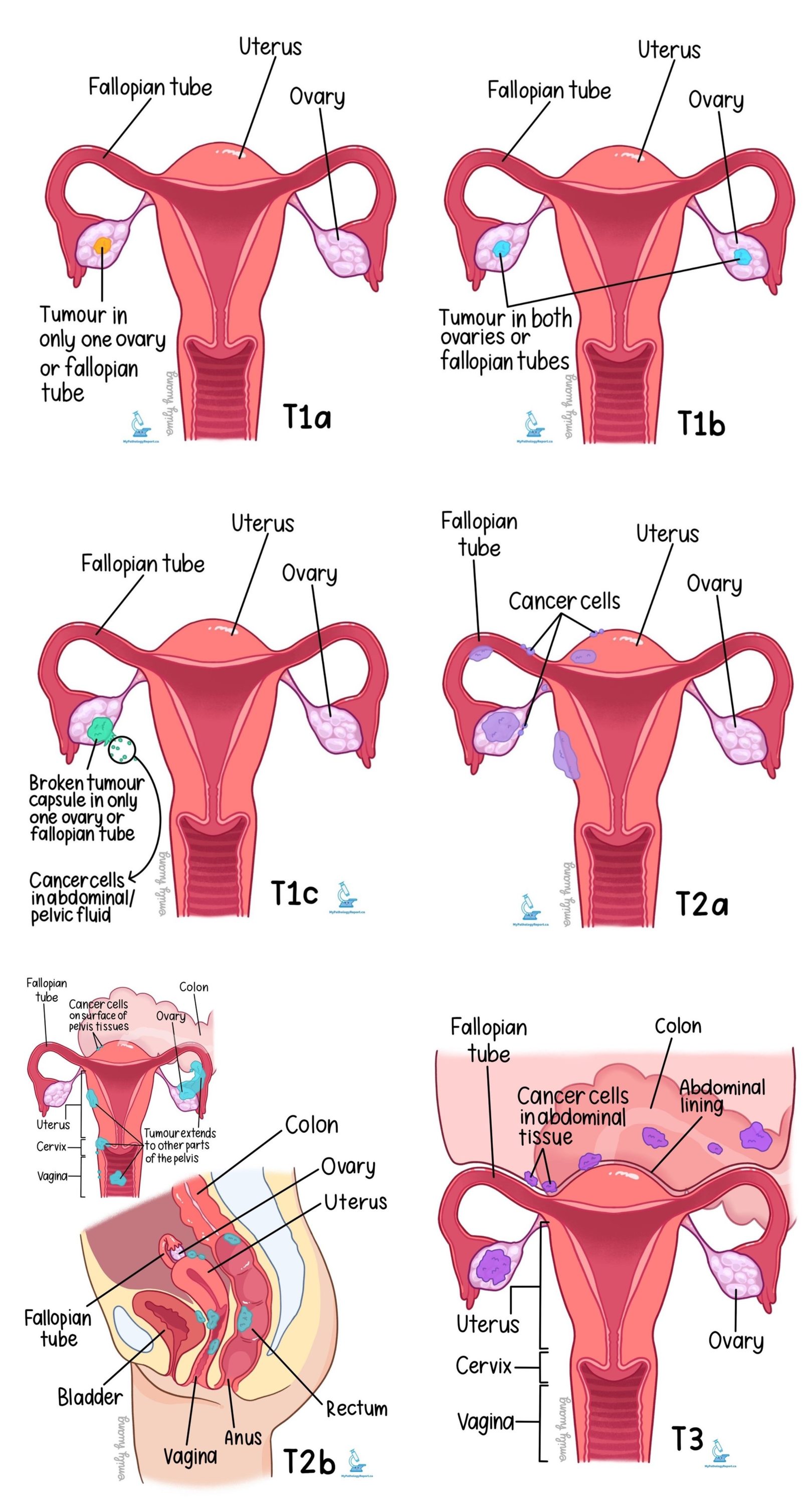 How Long Does It Take For Bone Marrow Biopsy Results