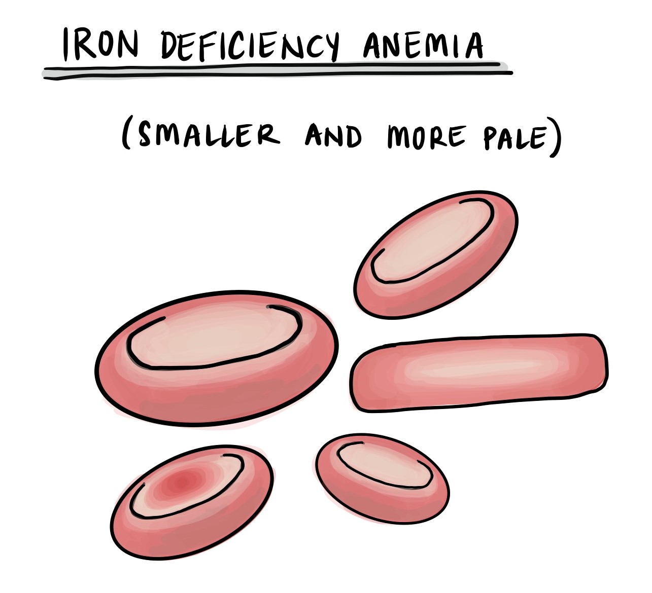 Iron Deficiency Anemia Ati Template