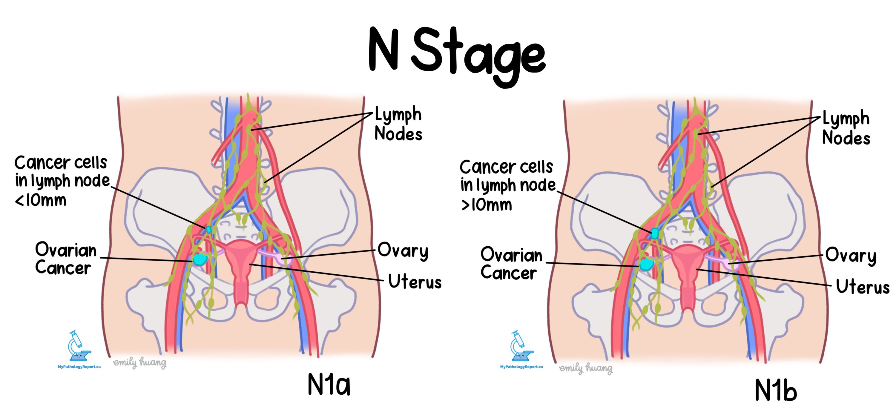 Node stage ovary cancer