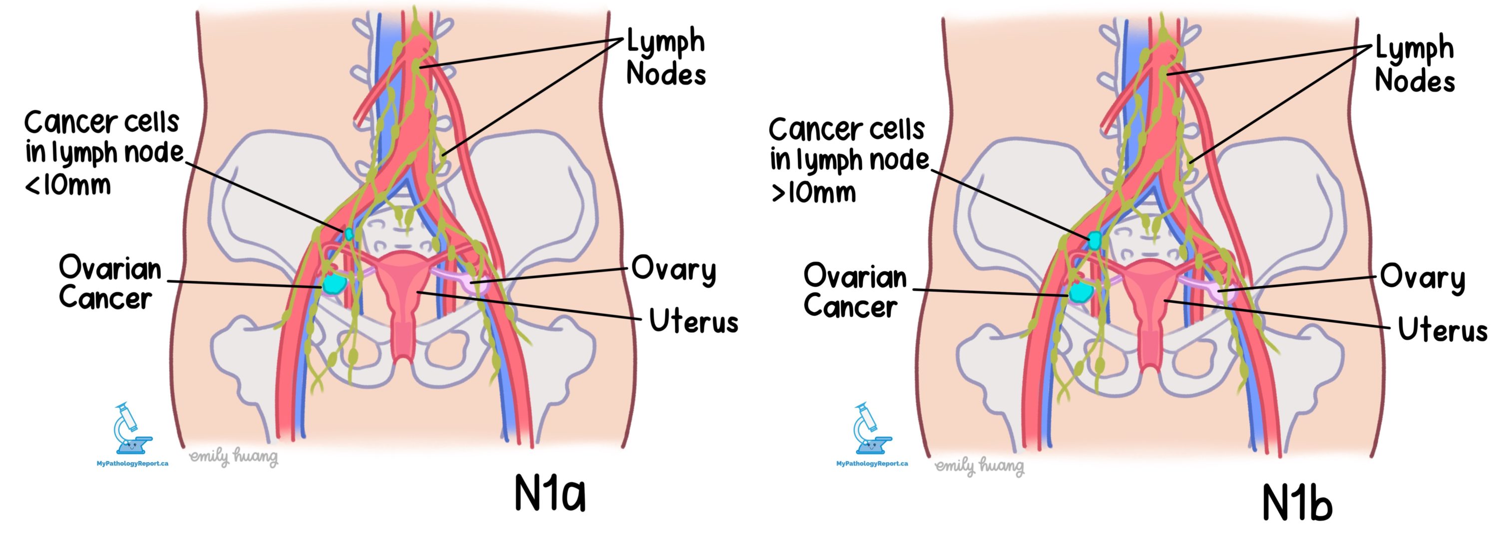 Ovary cancer nodal stage