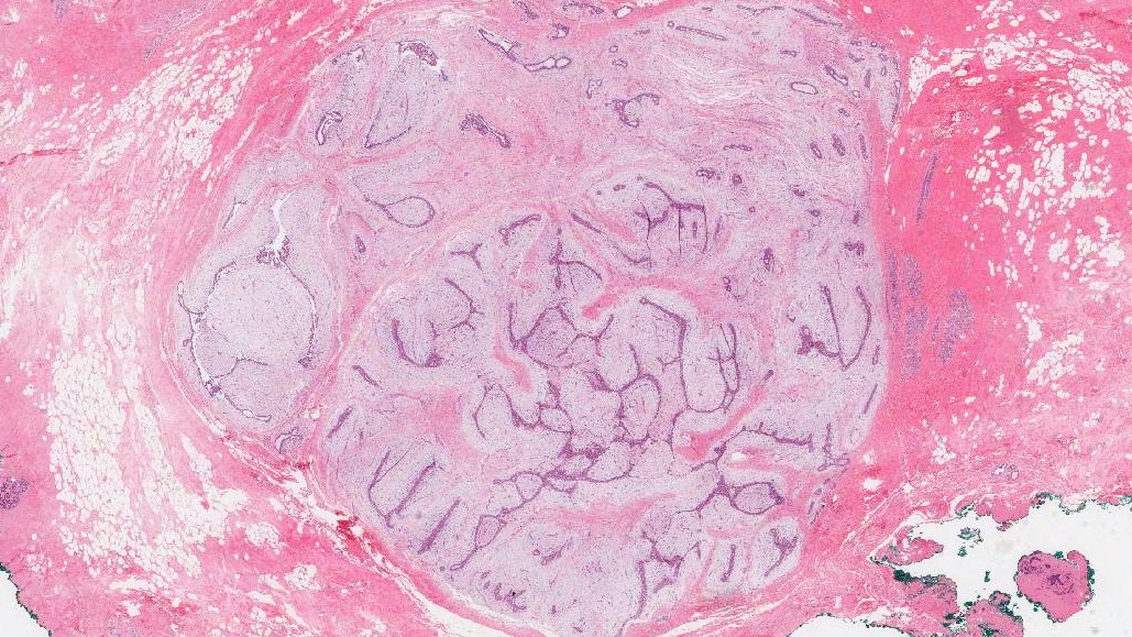 fibroadenoma de mama