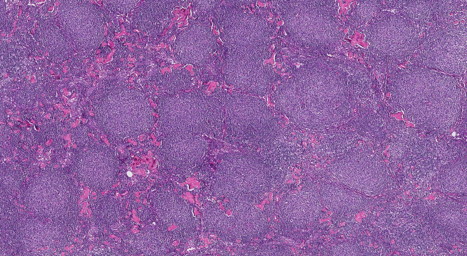 Follicular lymphoma. The small round structures seen in this picture are follicles made up of tumour cells.