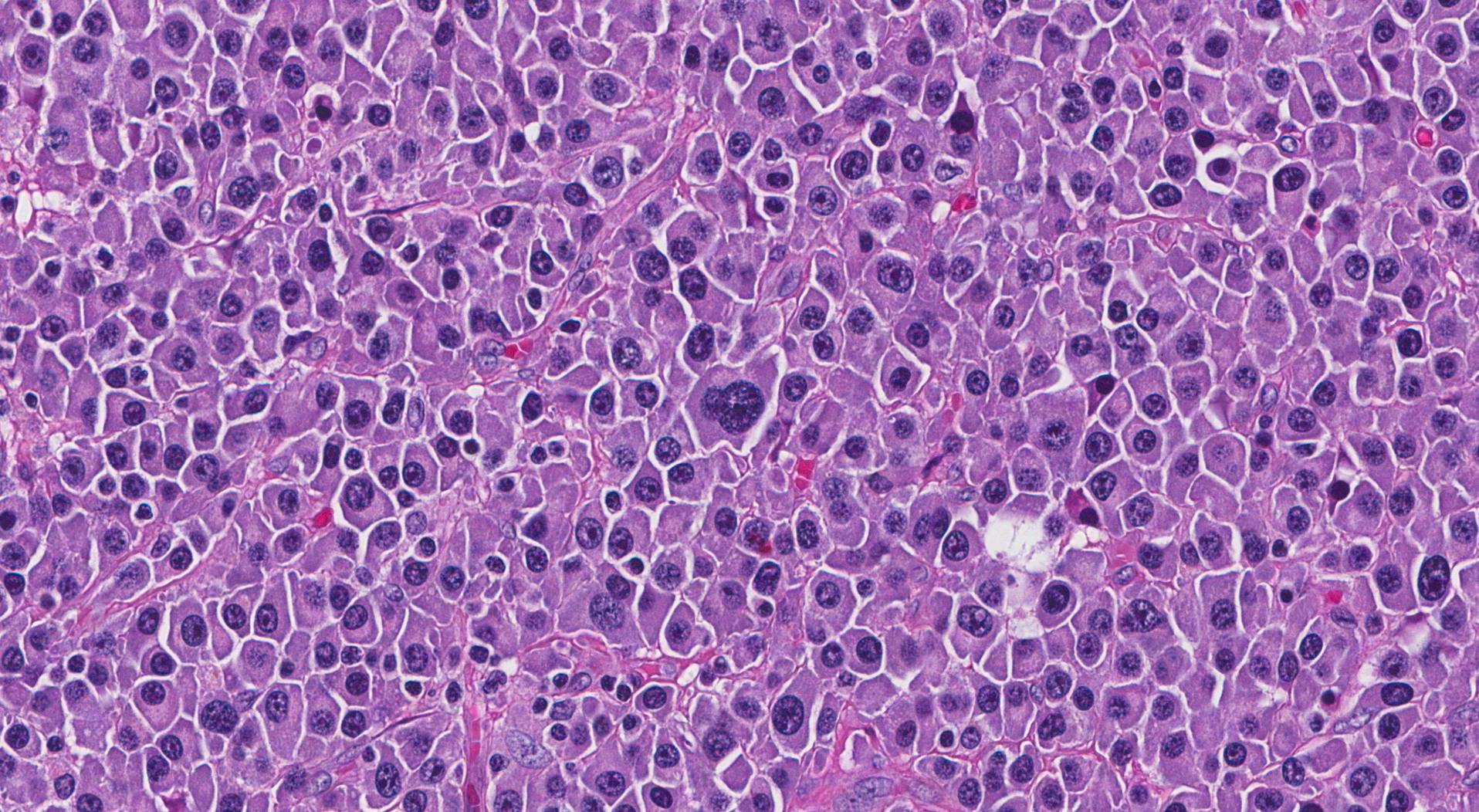 plasmacytoma