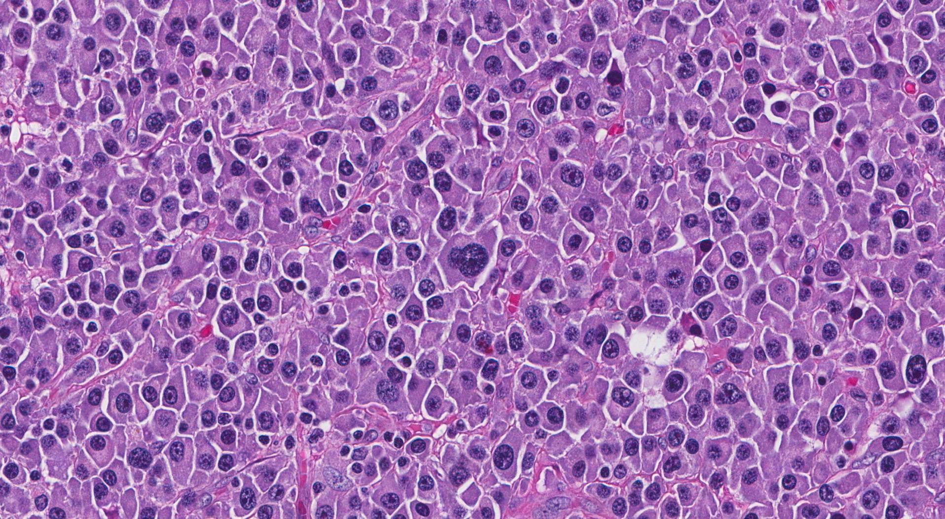 plasmacitoma