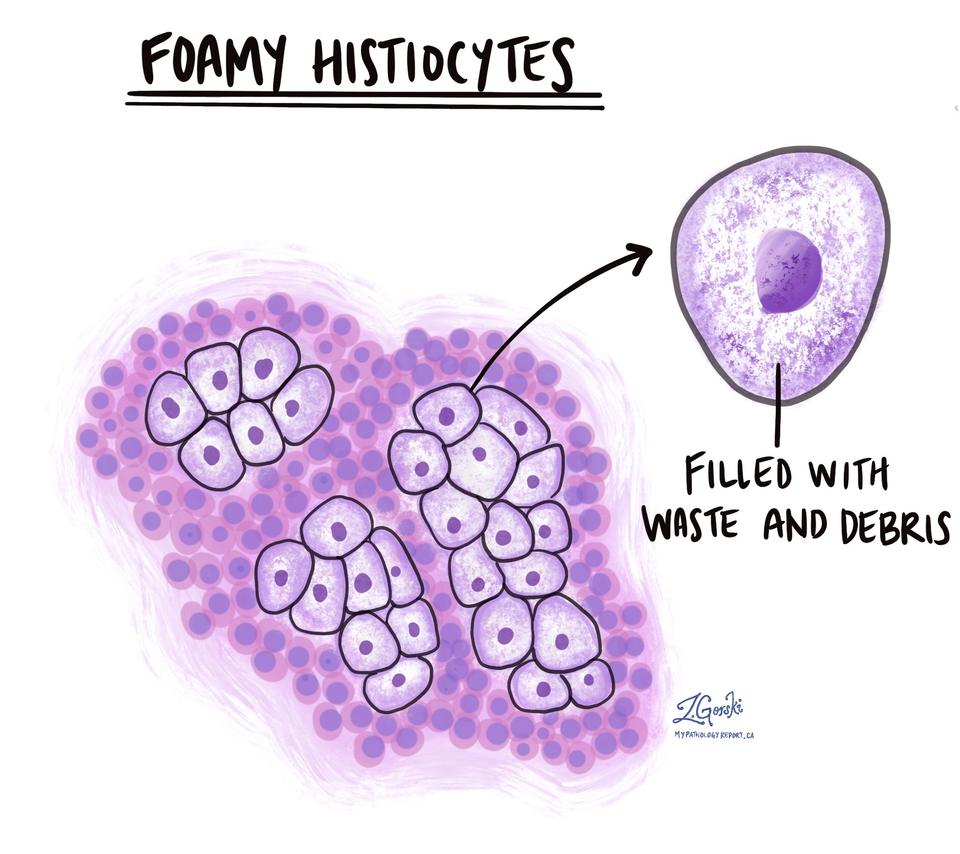foamy histiocytes