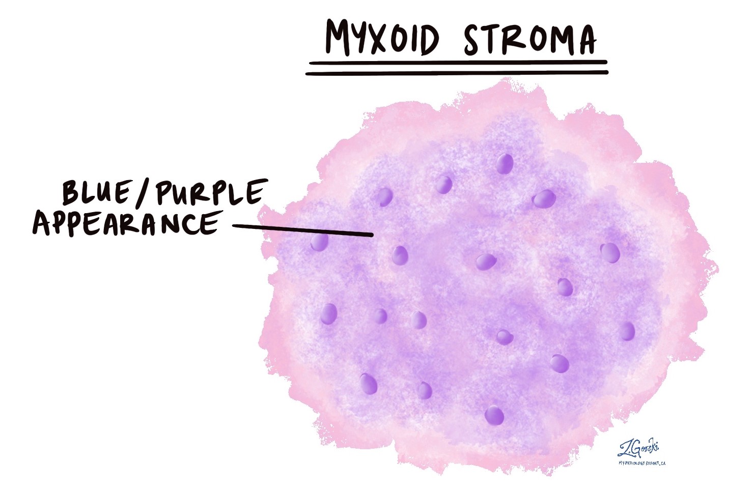 Myxoid 病理学辞書 Mypathologyreport Ca Myxoid 病理学辞書 Mypathologyreport Ca