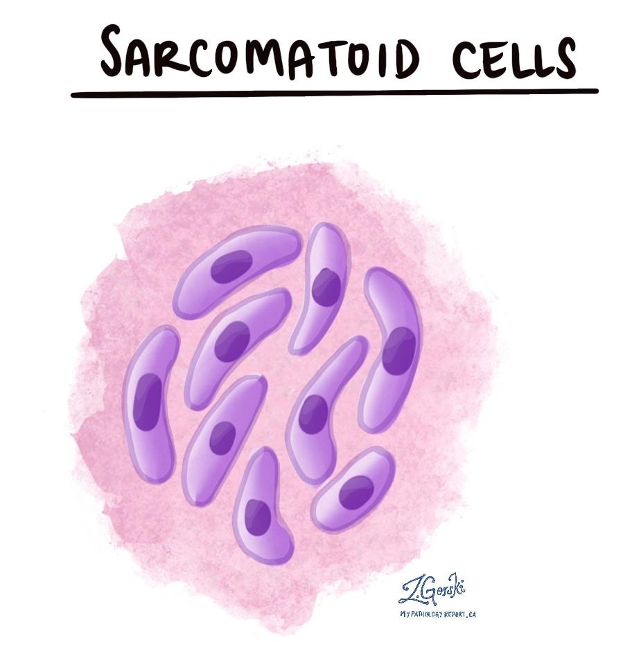sarcomatoid